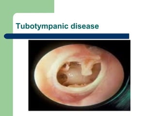 Tubotympanic disease
 