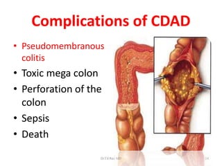 Clostridium difficile by Dr.T.V.Rao MD | PPTX