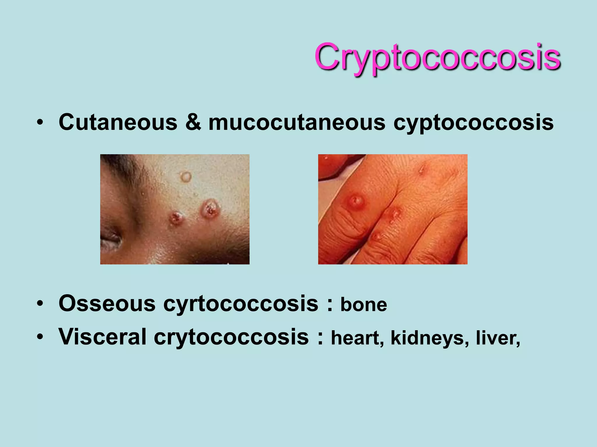 Cryptococcosis | PPT