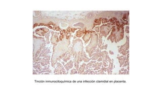 Tinción inmunocitoquímica de una infección clamidial en placenta.
 