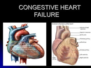 CONGESTIVE HEART
FAILURE
 