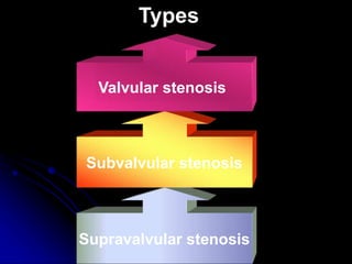 Supravalvular stenosis
Subvalvular stenosis
Types
Valvular stenosis
 