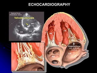 Valvular stenosis
ECHOCARDIOGRAPHY
 
