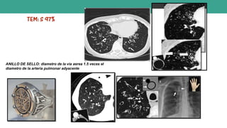 ANILLO DE SELLO: diametro de la via aerea 1.5 veces el
diametro de la arteria pulmonar adyacente
 