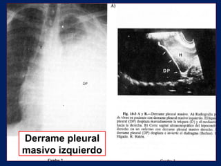 Derrame pleural
masivo izquierdo
 