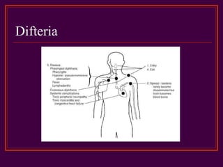 Difteria
 