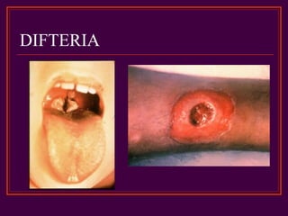 DIFTERIA
 