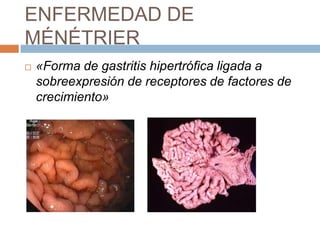 ENFERMEDAD DE
MÉNÉTRIER


«Forma de gastritis hipertrófica ligada a
sobreexpresión de receptores de factores de
crecimiento»

 