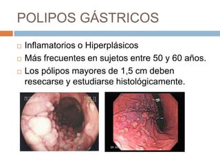 POLIPOS GÁSTRICOS




Inflamatorios o Hiperplásicos
Más frecuentes en sujetos entre 50 y 60 años.
Los pólipos mayores de 1,5 cm deben
resecarse y estudiarse histológicamente.

 