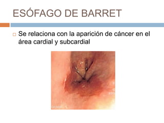 ESÓFAGO DE BARRET


Se relaciona con la aparición de cáncer en el
área cardial y subcardial

 