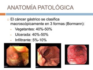 ANATOMÍA PATOLÓGICA


El cáncer gástrico se clasifica
macroscópicamente en 3 formas (Bormann):

Vegetantes: 40%-50%

Ulcerada: 40%-50%

Infiltrante: 5%-10%

 