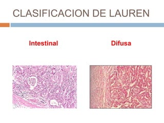 CLASIFICACION DE LAUREN
Intestinal

Difusa

 
