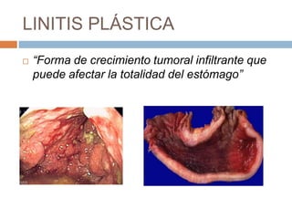 LINITIS PLÁSTICA


“Forma de crecimiento tumoral infiltrante que
puede afectar la totalidad del estómago”

 