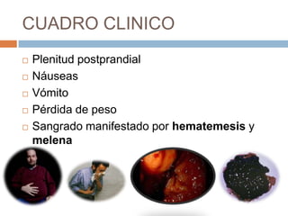 CUADRO CLINICO







Plenitud postprandial
Náuseas
Vómito
Pérdida de peso
Sangrado manifestado por hematemesis y
melena

 