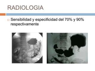 RADIOLOGIA


Sensibilidad y especificidad del 70% y 90%
respectivamente

 