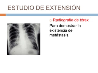 ESTUDIO DE EXTENSIÓN
Radiografía de tórax
Para demostrar la
existencia de
metástasis.


 