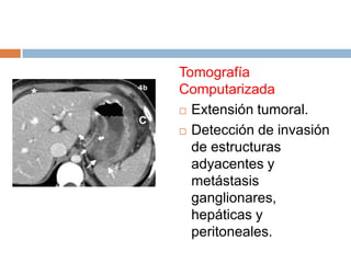 Tomografía
Computarizada
 Extensión tumoral.
 Detección de invasión
de estructuras
adyacentes y
metástasis
ganglionares,
hepáticas y
peritoneales.

 