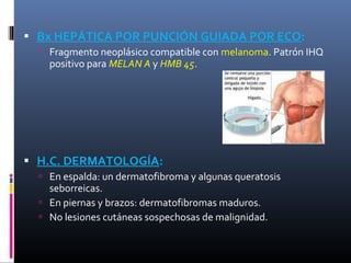  Bx HEPÁTICA POR PUNCIÓN GUIADA POR ECO:
   Fragmento neoplásico compatible con melanoma. Patrón IHQ
    positivo para MELAN A y HMB 45.




 H.C. DERMATOLOGÍA:
   En espalda: un dermatofibroma y algunas queratosis
    seborreicas.
   En piernas y brazos: dermatofibromas maduros.
   No lesiones cutáneas sospechosas de malignidad.
 