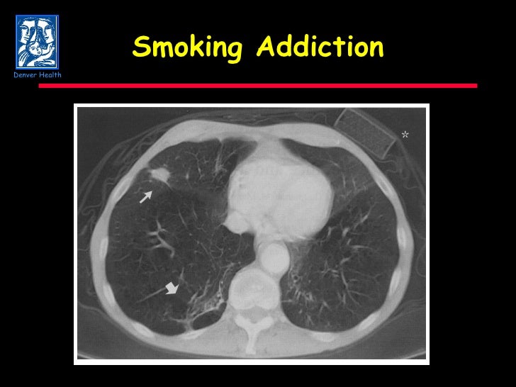 C O P D :State of the Art