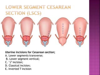 Uterine incisions for Cesarean section;
A. Lower segments transverse;
B. Lower segment vertical;
C. ‘J’ incision;
D. Classical incision;
E. Inverted T incision
 