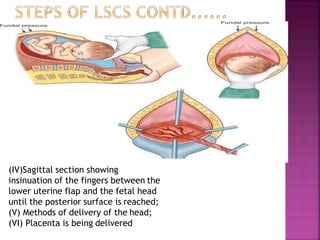 (IV)Sagittal section showing
insinuation of the fingers between the
lower uterine flap and the fetal head
until the posterior surface is reached;
(V) Methods of delivery of the head;
(VI) Placenta is being delivered
 