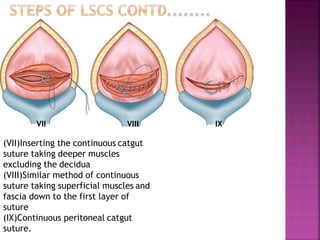 VII VIII IX
(VII)Inserting the continuous catgut
suture taking deeper muscles
excluding the decidua
(VIII)Similar method of continuous
suture taking superficial muscles and
fascia down to the first layer of
suture
(IX)Continuous peritoneal catgut
suture.
 