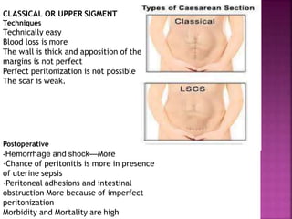CLASSICAL OR UPPER SIGMENT
Techniques
Technically easy
Blood loss is more
The wall is thick and apposition of the
margins is not perfect
Perfect peritonization is not possible
The scar is weak.
Postoperative
-Hemorrhage and shock—More
-Chance of peritonitis is more in presence
of uterine sepsis
-Peritoneal adhesions and intestinal
obstruction More because of imperfect
peritonization
Morbidity and Mortality are high
 