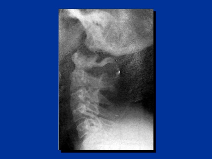 Cervical Spine Injury C Spine Clearing the Cervical Spine