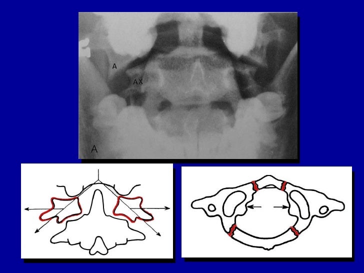 Cervical Spine Injury C Spine Clearing the Cervical Spine