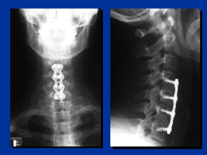Cervical Spine Injury C Spine Clearing the Cervical Spine