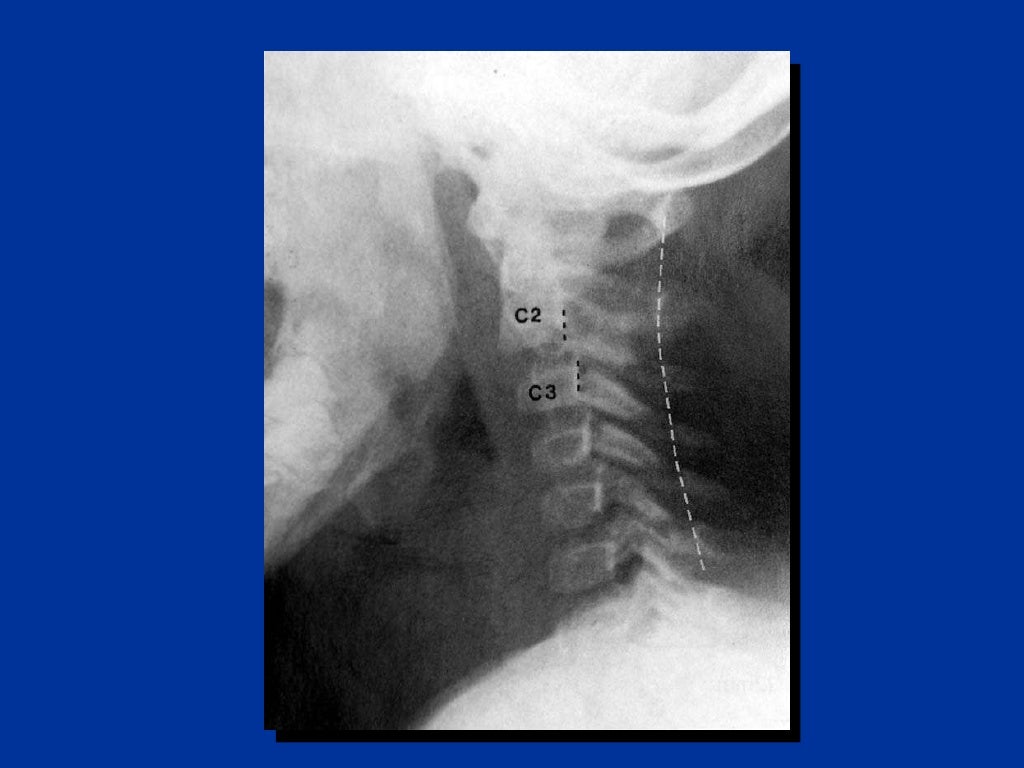 Cervical Spine Injury C Spine Clearing the Cervical Spine