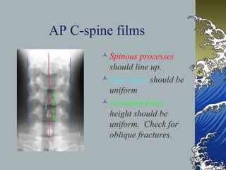 Cd Spine Example C spine fractures final | PPT