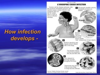 C05 P12 WHOOPING COUGH Community Medicine.ppt
