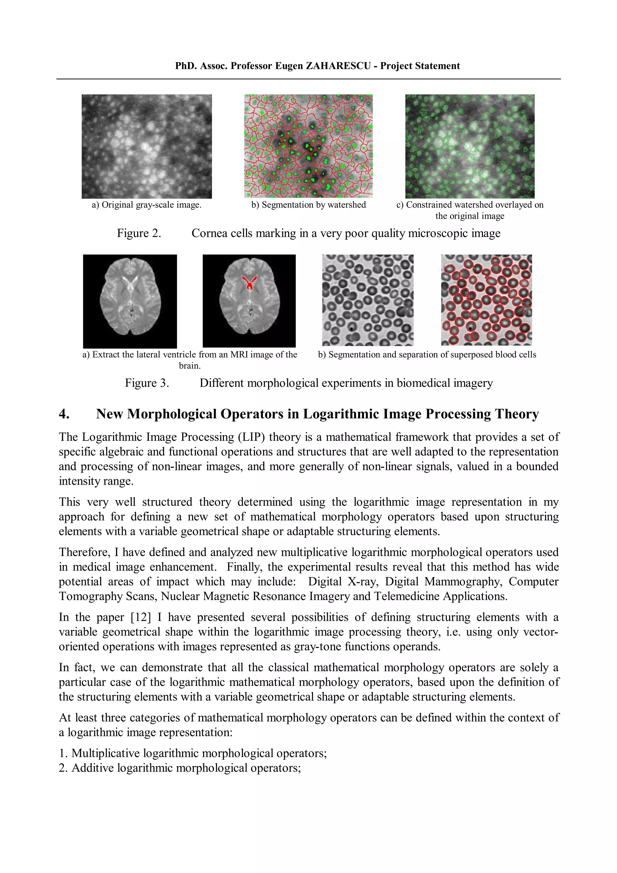 PhD. Assoc. Professor Eugen ZAHARESCU - Project Statement
a) Original gray-scale image. b) Segmentation by watershed c) Constrained watershed overlayed on
the original image
Figure 2. Cornea cells marking in a very poor quality microscopic image
a) Extract the lateral ventricle from an MRI image of the
brain.
b) Segmentation and separation of superposed blood cells
Figure 3. Different morphological experiments in biomedical imagery
4. New Morphological Operators in Logarithmic Image Processing Theory
The Logarithmic Image Processing (LIP) theory is a mathematical framework that provides a set of
specific algebraic and functional operations and structures that are well adapted to the representation
and processing of non-linear images, and more generally of non-linear signals, valued in a bounded
intensity range.
This very well structured theory determined using the logarithmic image representation in my
approach for defining a new set of mathematical morphology operators based upon structuring
elements with a variable geometrical shape or adaptable structuring elements.
Therefore, I have defined and analyzed new multiplicative logarithmic morphological operators used
in medical image enhancement. Finally, the experimental results reveal that this method has wide
potential areas of impact which may include: Digital X-ray, Digital Mammography, Computer
Tomography Scans, Nuclear Magnetic Resonance Imagery and Telemedicine Applications.
In the paper [12] I have presented several possibilities of defining structuring elements with a
variable geometrical shape within the logarithmic image processing theory, i.e. using only vector-
oriented operations with images represented as gray-tone functions operands.
In fact, we can demonstrate that all the classical mathematical morphology operators are solely a
particular case of the logarithmic mathematical morphology operators, based upon the definition of
the structuring elements with a variable geometrical shape or adaptable structuring elements.
At least three categories of mathematical morphology operators can be defined within the context of
a logarithmic image representation:
1. Multiplicative logarithmic morphological operators;
2. Additive logarithmic morphological operators;
 