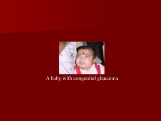 A baby with congenital glaucoma
 