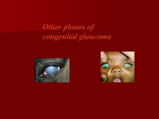 Other photos of
congenital glaucoma
 