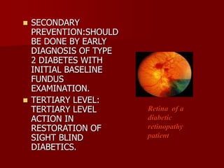  SECONDARY
PREVENTION:SHOULD
BE DONE BY EARLY
DIAGNOSIS OF TYPE
2 DIABETES WITH
INITIAL BASELINE
FUNDUS
EXAMINATION.
 TERTIARY LEVEL:
TERTIARY LEVEL
ACTION IN
RESTORATION OF
SIGHT BLIND
DIABETICS.
Retina of a
diabetic
retinopathy
patient
 