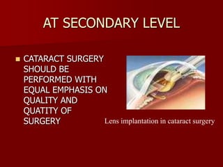 AT SECONDARY LEVEL
 CATARACT SURGERY
SHOULD BE
PERFORMED WITH
EQUAL EMPHASIS ON
QUALITY AND
QUATITY OF
SURGERY Lens implantation in cataract surgery
 