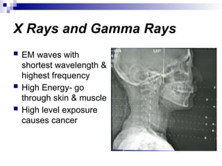 X Rays and Gamma Rays
 EM waves with
shortest wavelength &
highest frequency
 High Energy- go
through skin & muscle
 High level exposure
causes cancer
 