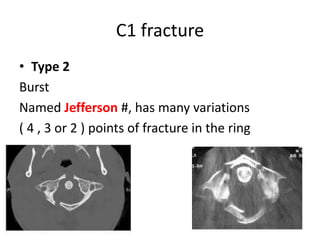 C1 fracture
• Type 2
Burst
Named Jefferson #, has many variations
( 4 , 3 or 2 ) points of fracture in the ring
 
