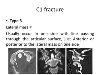 C1 fracture
• Type 3
Lateral mass #
Usually occur in one side with line passing
through the articular surface, just Anterior or
posterior to the lateral mass on one side
 