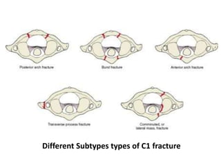 Different Subtypes types of C1 fracture
 