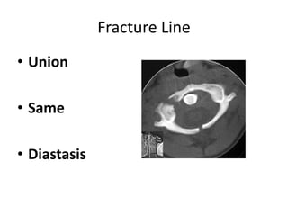 Fracture Line
• Union
• Same
• Diastasis
 