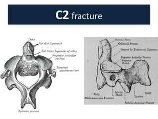 C2 fracture
 