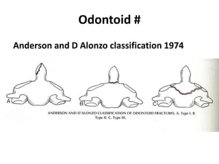 Odontoid #
Anderson and D Alonzo classification 1974
 