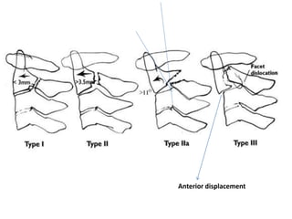 Anterior displacement
 