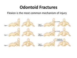 Odontoid Fractures
Flexion is the most common mechanism of injury
 