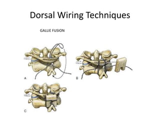 Dorsal Wiring Techniques
GALLIE FUSION
 