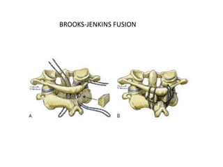 BROOKS-JENKINS FUSION
 