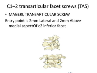 C1–2 transarticular facet screws (TAS)
• MAGERL TRANSARTICULAR SCREW
Entry point is 2mm Lateral and 2mm Above
medial aspectOf c2 inferior facet
 